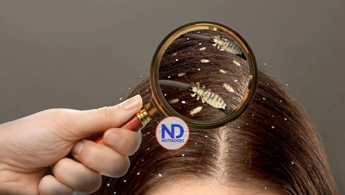 Cómo tratar y prevenir el contagio de piojos en los niños
