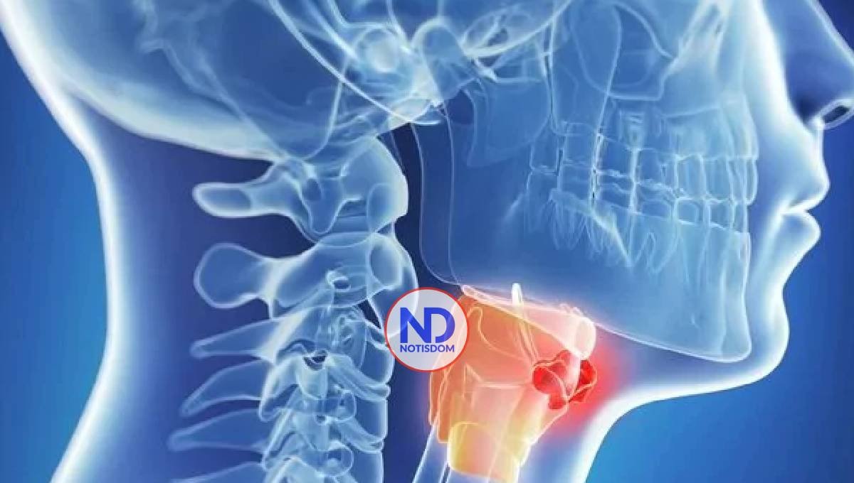 Conozca tres maneras de prevenir el cáncer de cabeza y cuello