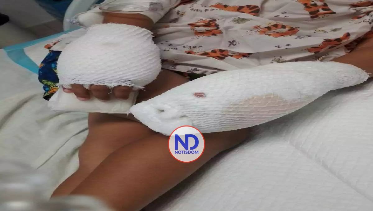 Mujer acusada de causar graves quemaduras en las manos a su hijo en La Vega