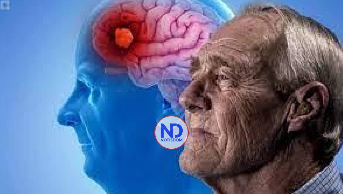 La prevención del Alzheimer 2 La prevención del Alzheimer