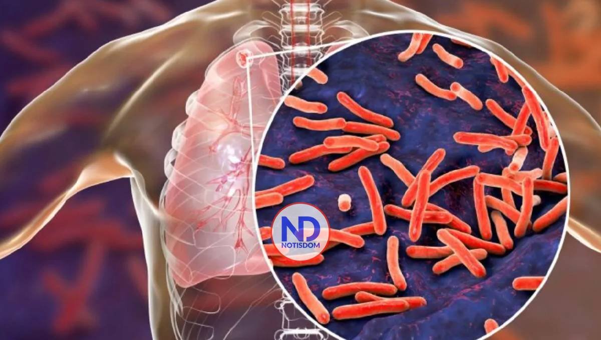 La tuberculosis, principal causa de muerte en la República Centroafricana 2 La tuberculosis, principal causa de muerte en la República Centroafricana