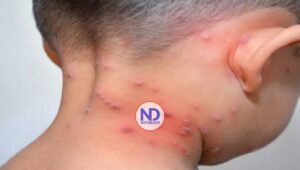 Salud Pública notifica un brote varicela en escuela Santo Domingo Este