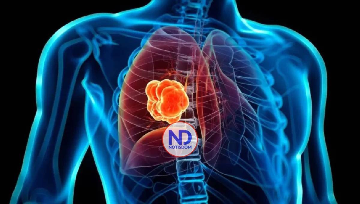 Presentan en el país medicamento contra cáncer de pulmón