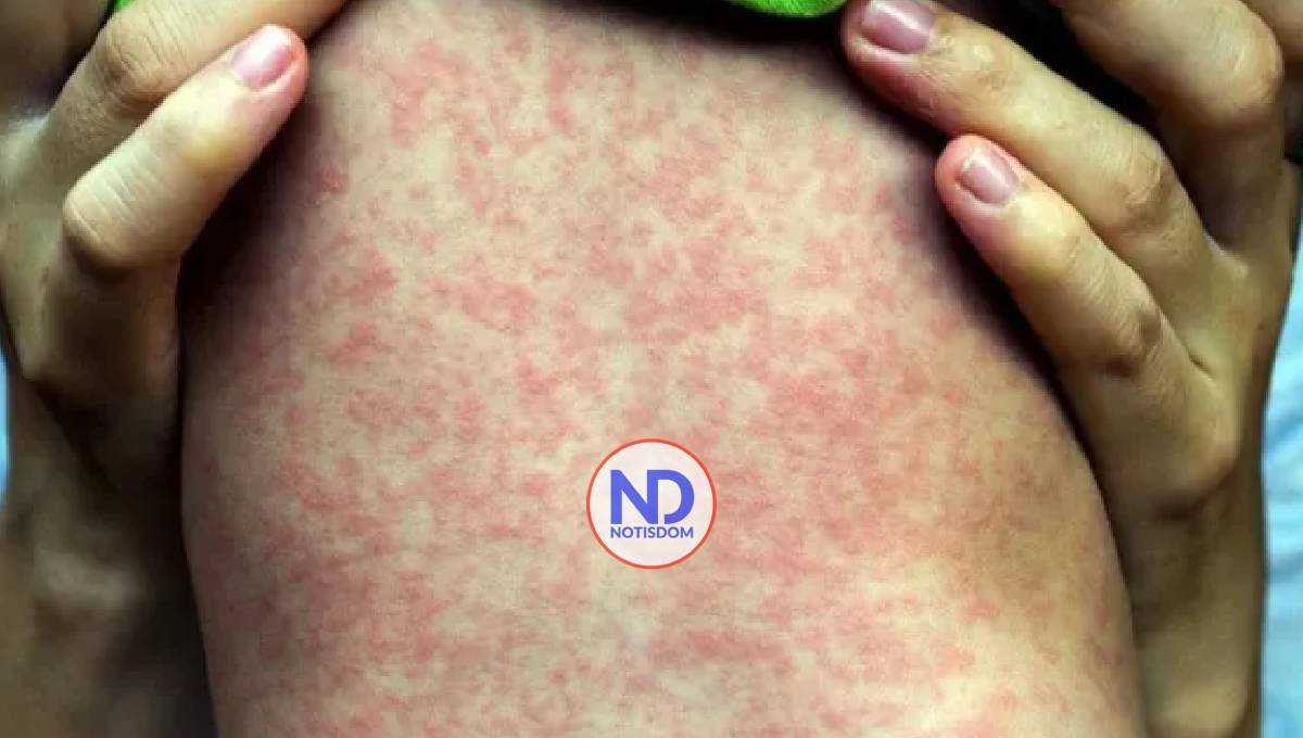 RD sigue libre de sarampión, pero fortalece vigilancia epidemiológica