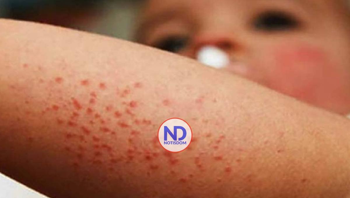 Resurge el riesgo del retorno del sarampión en Dominicana