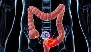 Asocian aumento del cáncer de colon en jóvenes con una infección bacteriana en la infancia