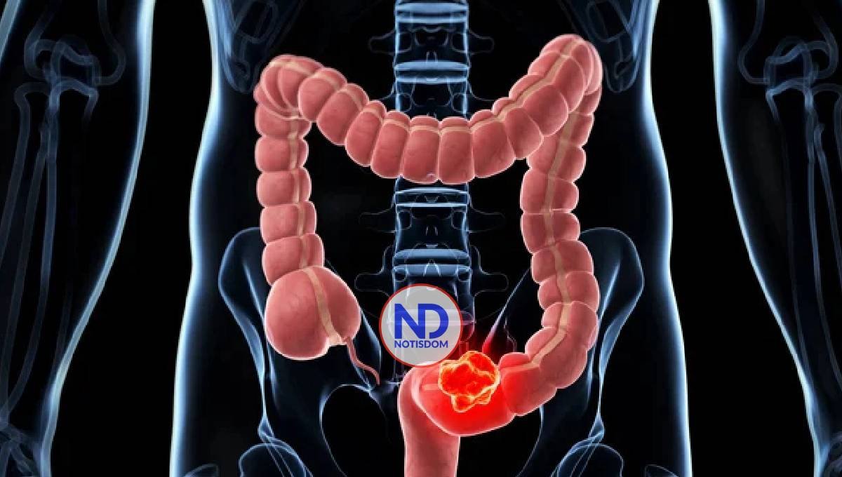 Asocian aumento del cáncer de colon en jóvenes con una infección bacteriana en la infancia