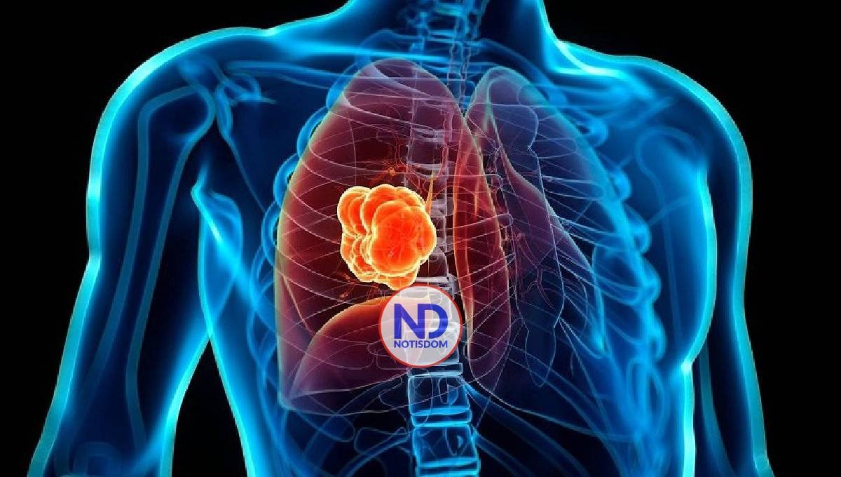 La inmunoterapia sustituiría la cirugía diagnósticos de cáncer