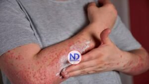 Injertos de piel modificados genéticamente podrían ayudar a tratar la «piel de mariposa»