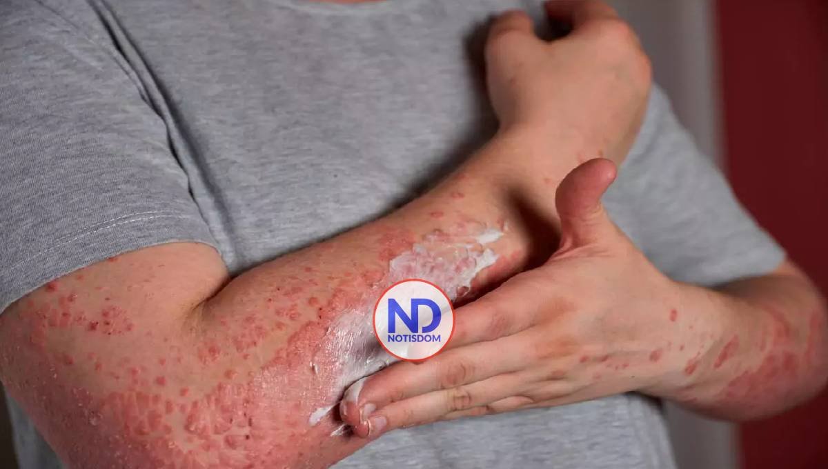 Injertos de piel modificados genéticamente podrían ayudar a tratar la «piel de mariposa»