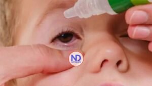 Conoce qué es la conjuntivitis alérgica y bacteriana en el infante, y cómo tratarlas