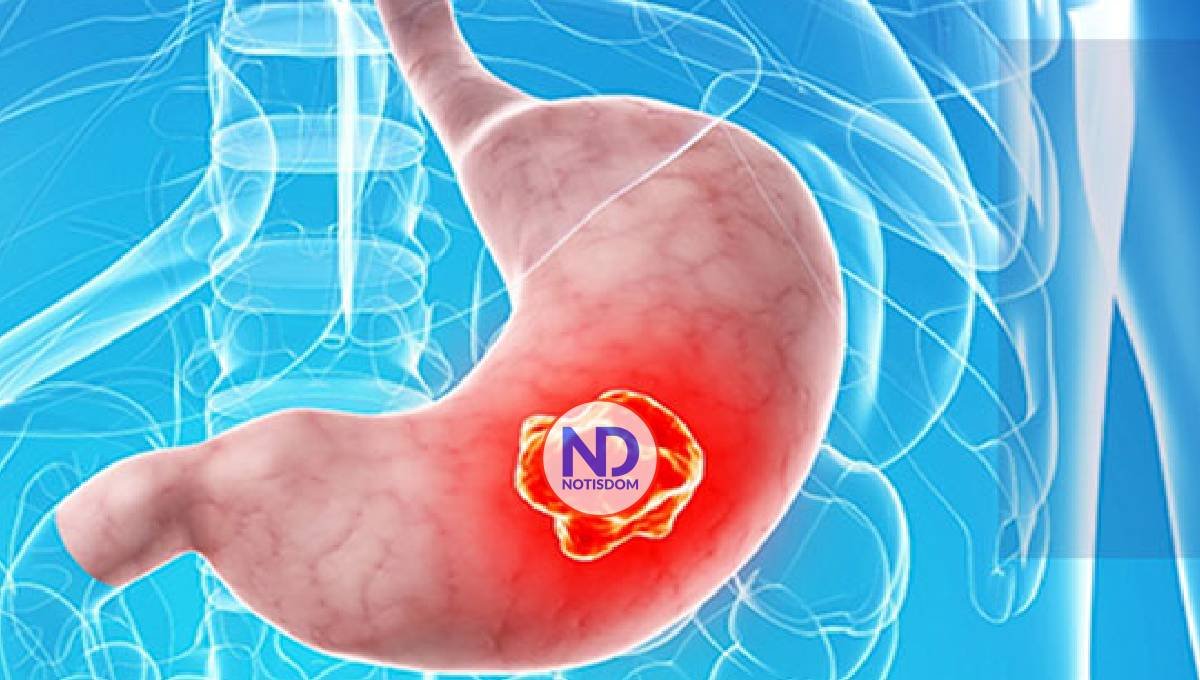 Estudio prevé millones casos de cáncer gástrico a nivel mundial
