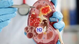 Bacteria modificada promete combatir cálculos renales