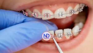 Brackets metálicos o estéticos: transforman la sonrisa para siempre