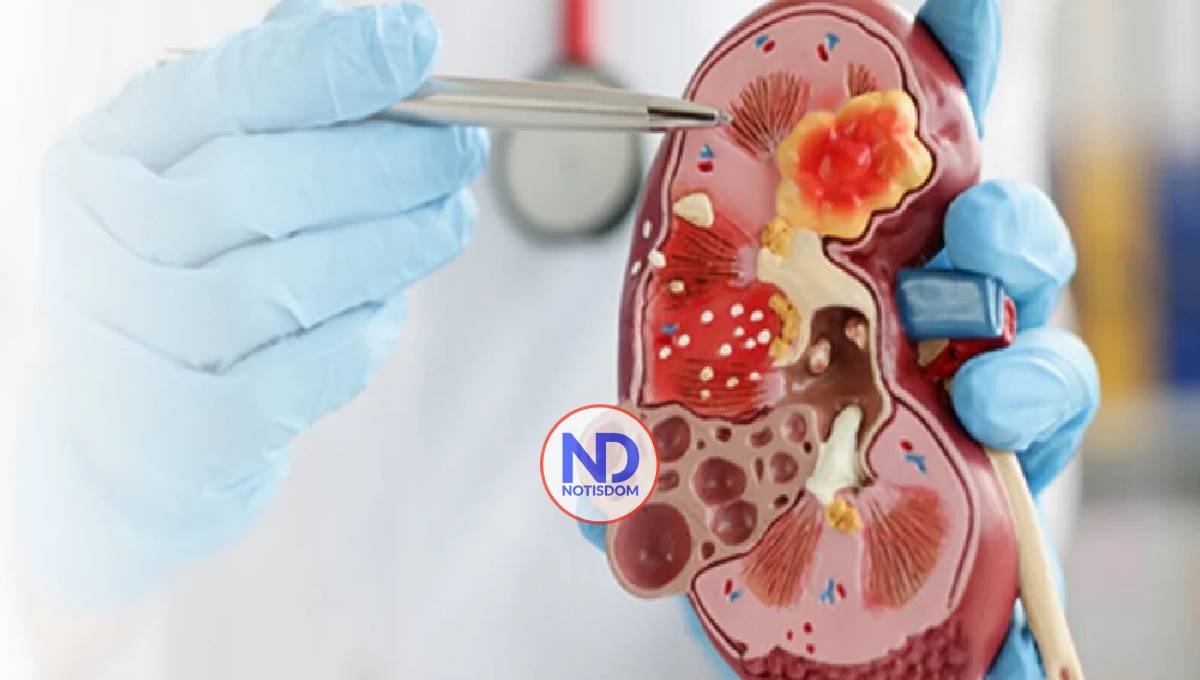 Enfermedad renal diabética; ¿qué es y cómo prevenirla?
