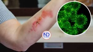 No se ha confirmado presencia de «bacteria carnívora» en RD