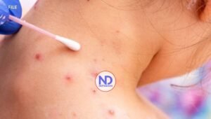 Confirman un caso de sarampión en Paraguay tras diez años sin circulación del virus