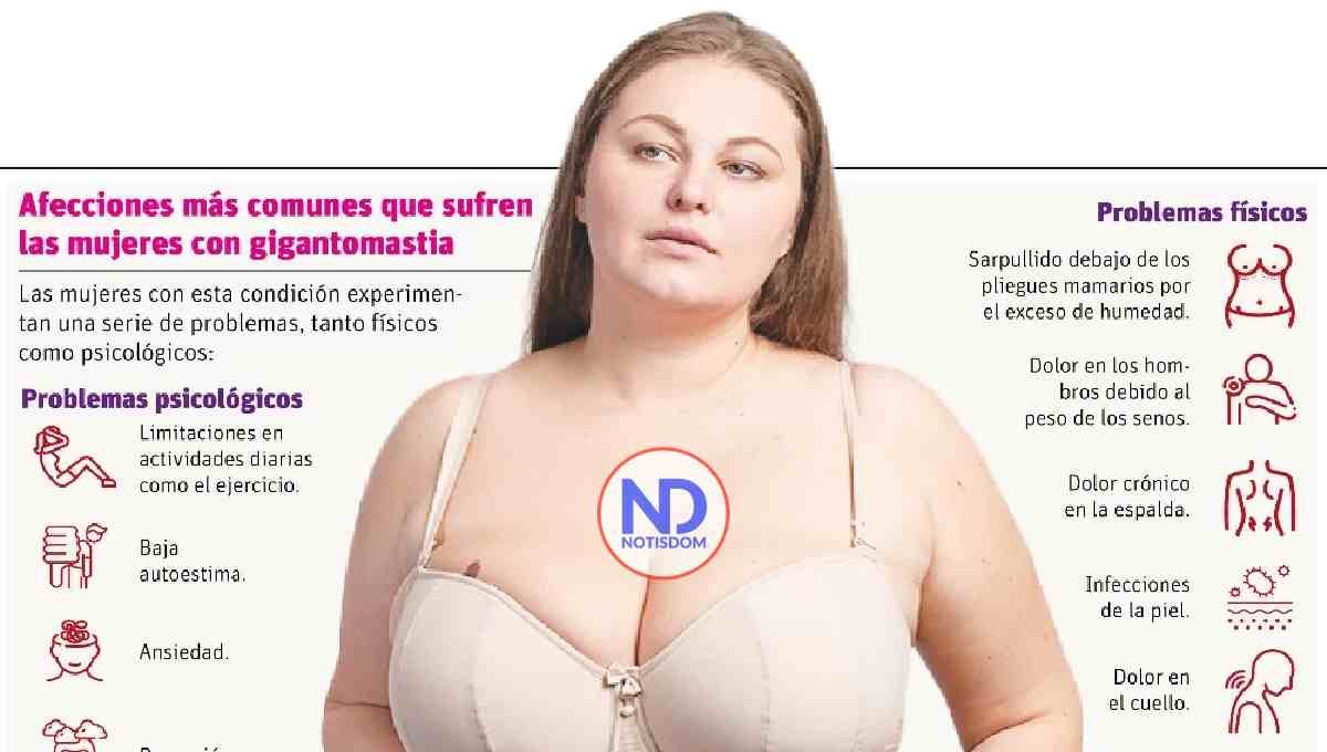 Gigantomastia, condición que afecta salud física y emocional de la mujer