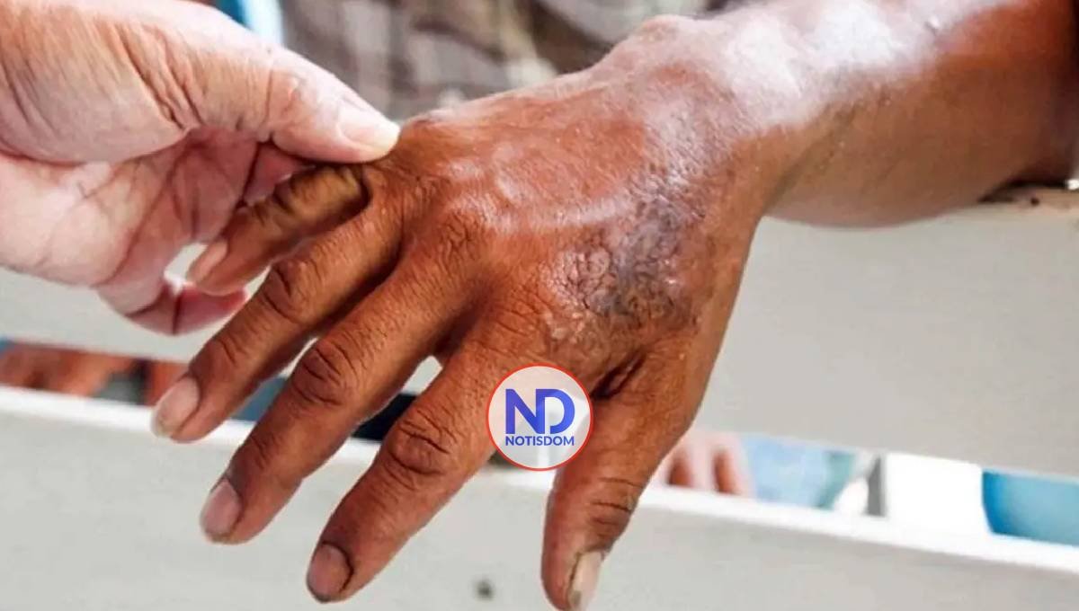 Septiembre es el Mes de la Lepra: Una oportunidad para educar, sensibilizar y sanar