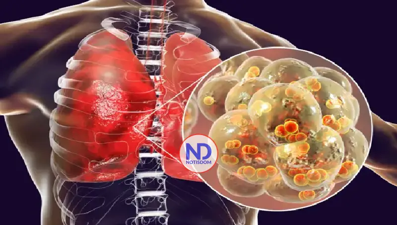 Neumonía: la infección que aún amenaza millones de vidas en el mundo