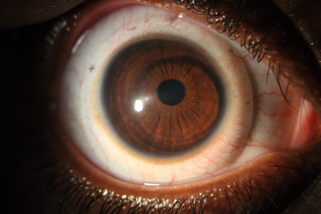 Lente de contacto escleral en queratocono 200 mil dominicanos podrían padecer queratocono sin saberlo