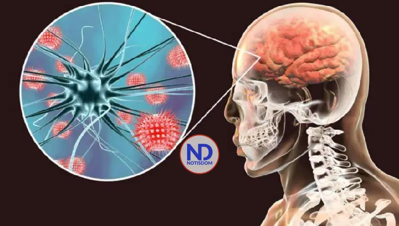 Salud registra aumento de casos probables de enfermedad meningocócica; suman 26 hasta noviembre  