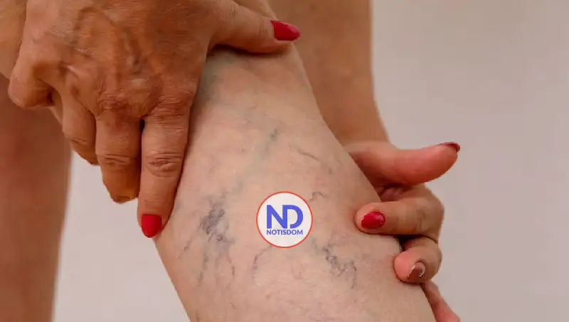 Medias de compresión, la aliada clave para combatir las várices y mejorar la circulación 2 Medias de compresión, la aliada clave para combatir las várices y mejorar la circulación