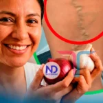 Cebolla y ajo: ayudan, previenen y alivian, pero no curan las várices, advierten especialistas