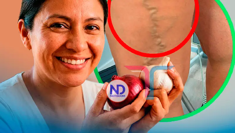 Cebolla y ajo: ayudan, previenen y alivian, pero no curan las várices, advierten especialistas