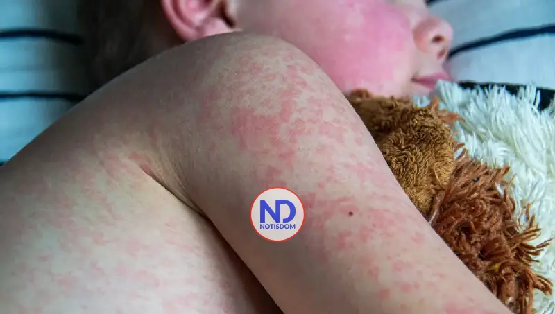 Casos de sarampión en Guatemala crecen un 75 % en solo una semana