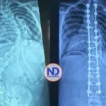 Hospital Reid Cabral y Rehabilitación superan 350 cirugías de escoliosis pediátrica