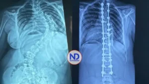 Hospital Reid Cabral y Rehabilitación superan 350 cirugías de escoliosis pediátrica