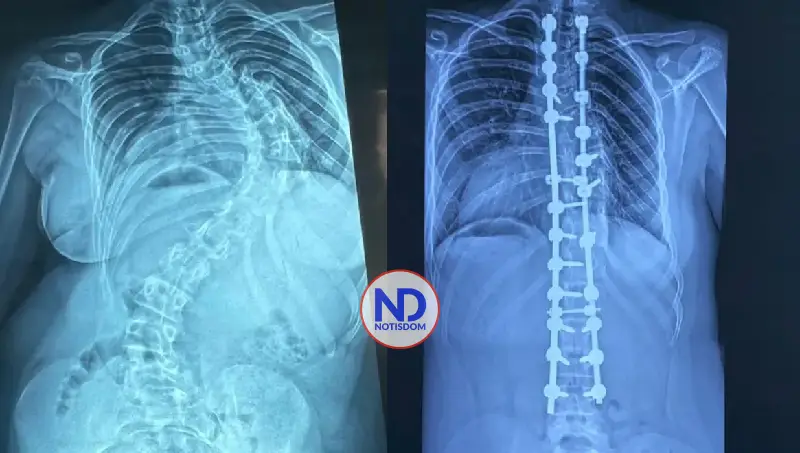 Hospital Reid Cabral y Rehabilitación superan 350 cirugías de escoliosis pediátrica 2 Hospital Reid Cabral y Rehabilitación superan 350 cirugías de escoliosis pediátrica