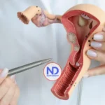 Identifican un marcador que predice la recaída en el cáncer de endometrio más común