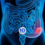 Cáncer de colon: detectarlo a tiempo salva hasta el 90 % de los pacientes