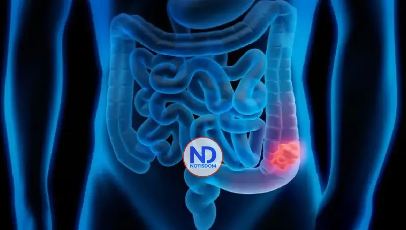 Cáncer de colon: detectarlo a tiempo salva hasta el 90 % de los pacientes