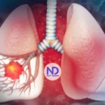 Sociedad Oncología dice 80% cáncer pulmón se asocia tabaco