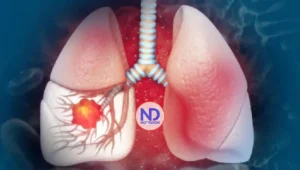 Sociedad Oncología dice 80% cáncer pulmón se asocia tabaco