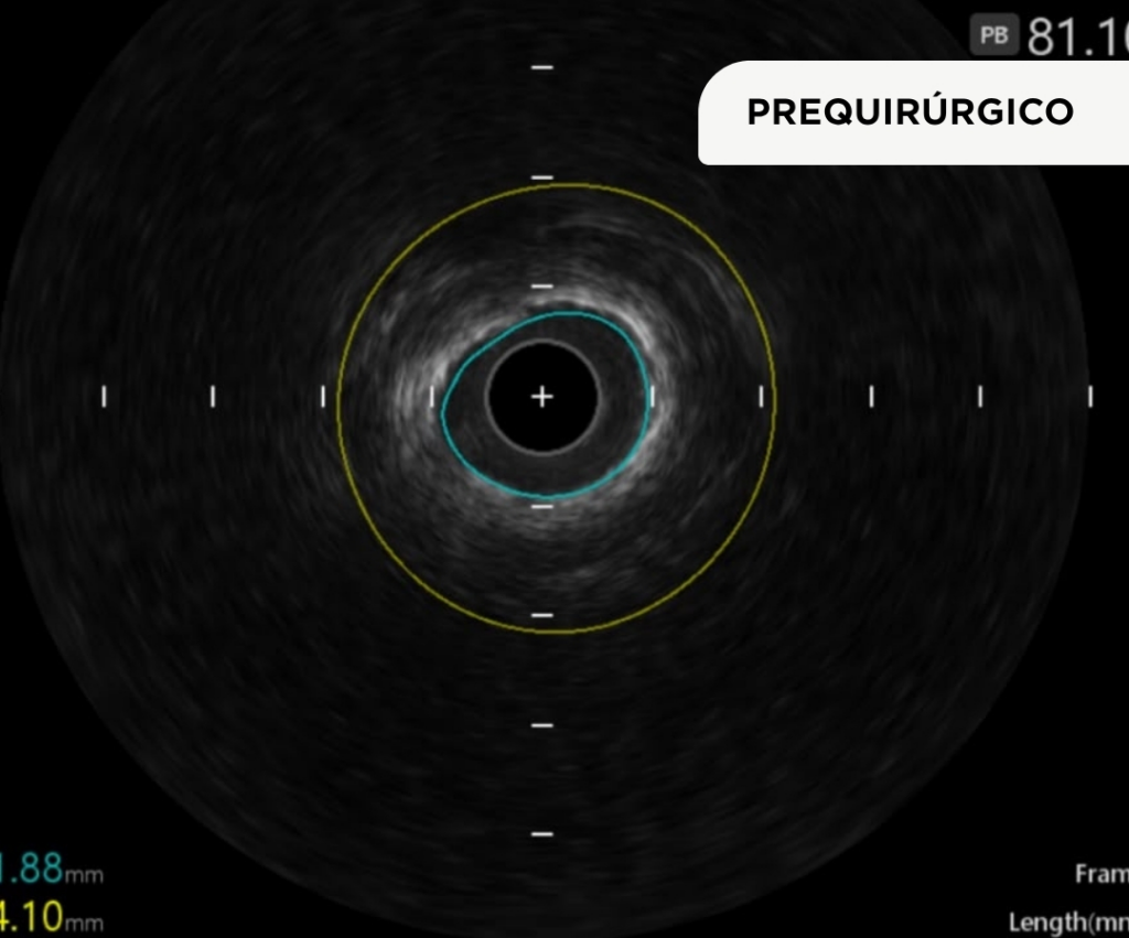 PREQUIRURGICO Cedimat realiza primer procedimiento de litotricia intravascular coronaria con balón en el país