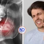 ¿Es necesario extraer las muelas del juicio? Expertos explican cuándo pueden conservarse