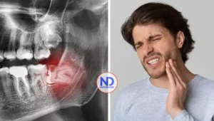 ¿Es necesario extraer las muelas del juicio? Expertos explican cuándo pueden conservarse