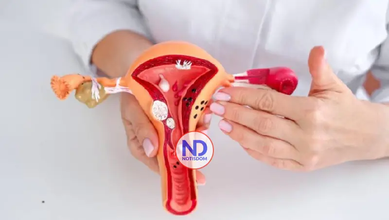 Endometriosis: enfermedad que puede comprometer la calidad de vida y la fertilidad