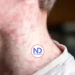 La OPS emite una alerta para aumentar la vacunación por el brote de sarampión en América