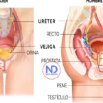 ¿Cómo afecta la calidad de vida en el paciente con estrechez uretral?